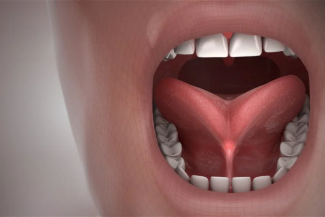 Ankyloglossia/Tongue Oral Restriction (Tongue Tie)