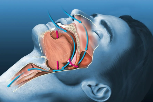 Apnea, Hypopnea, and Sleep Fragmentation